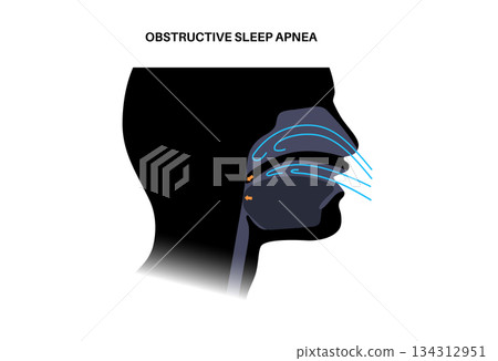 Obstructive sleep apnea 134312951