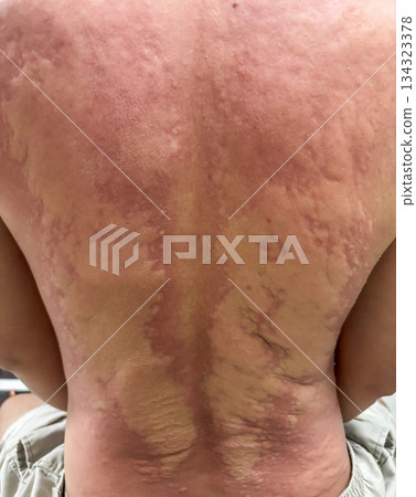 Young asian man itching and scratching on his back from allergic itchy dry skin eczema dermatitis insect bites 134323378