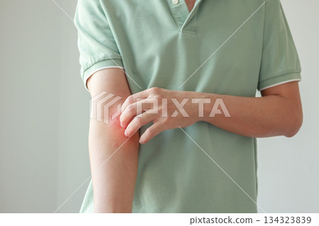 Young asian man itching and scratching on arm from allergic itchy dry skin eczema dermatitis insect bites Young asian man itching and scratching on arm from allergic itchy dry skin eczema dermatitis insect bites 134323839
