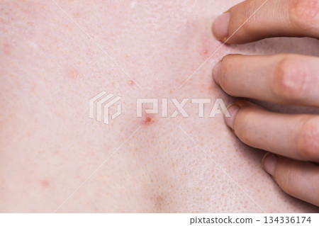 Woman dealing with pimples red spots Woman dealing with pimples red spots 134336174