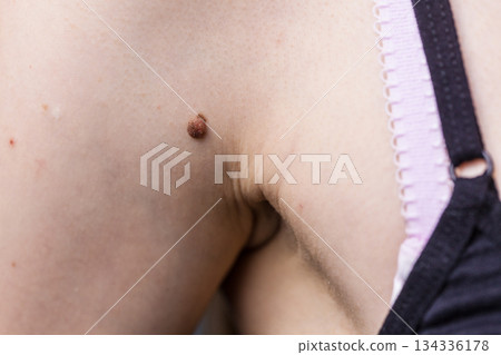 Person having dark fibroma, dermatology problem on skin. Close up of papilloma dermatosis 134336178