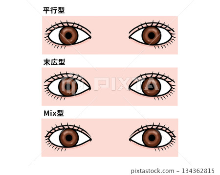 雙眼皮的類型 雙眼皮的類型 134362815