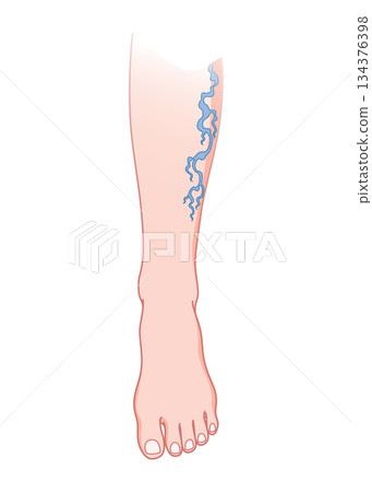 Varicose veins. Blue blood vessel visible through the skin, abnormally swollen leg. Vascular disease diagnostic and treatment. Venous insufficiency medical disease Varicose veins. Blue blood vessel visible through the skin, abnormally swollen leg. Vascular disease diagnostic and treatment. Venous insufficiency medical disease 134376398