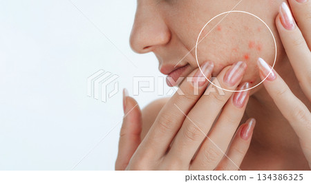 close-up female face with pimples and acne on white isolated background. Woman with problematic skin. Collage of problem skin before and after treatment and care. Clean healthy and bad unhealthy skin 134386325