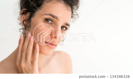 Portrait of young girl with pimples and acne on face close-up on a white background. Adult woman with problematic skin. Collage of bad problem skin before and clean healthy after treatment and care Portrait of young girl with pimples and acne on face close-up on a white background. Adult woman with problematic skin. Collage of bad problem skin before and clean healthy after treatment and care 134386326