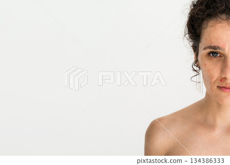close-up portrait of a young girl with red pimples and acne on face in close up on a white isolated background with copy space. A woman with problem skin close-up portrait of a young girl with red pimples and acne on face in close up on a white isolated background with copy space. A woman with problem skin 134386333