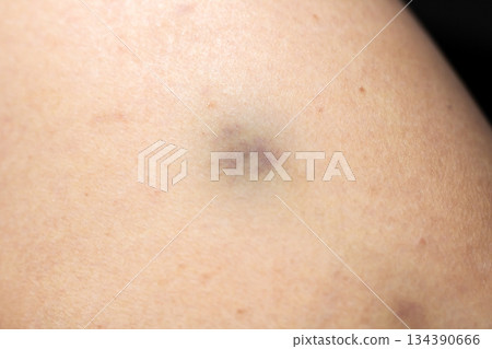 Highresolution image showcasing injury characteristics on pale skin with clinical lighting emphasis Highresolution image showcasing injury characteristics on pale skin with clinical lighting emphasis 134390666