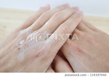 Applying moisturizing cream to dry, chapped hands. Applying moisturizing cream to dry, chapped hands. 134397040