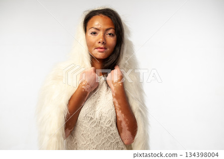 Young African woman with vitiligo wearing elegant Young African woman with vitiligo wearing elegant 134398004