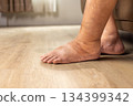 Elderly woman has edema or swelling foot. 134399342