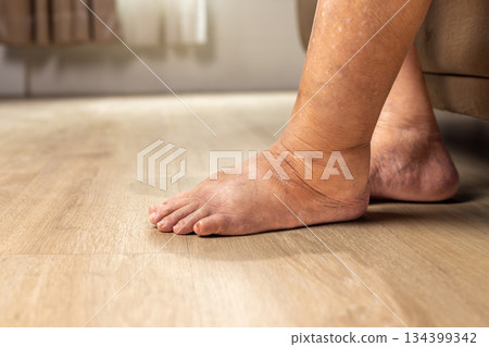 Elderly woman has edema or swelling foot. Elderly woman has edema or swelling foot. 134399342