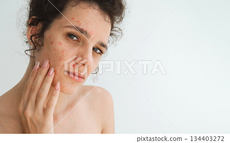 portrait of teen girl with pimples and acne on problematic facial skin. Face of young woman with bad red inflamed skin and acne in close-up on white background 134403272