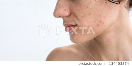 portrait of a young teenage girl with pimples and acne on problematic facial skin. Face of female with bad red inflamed skin and acne in close-up on white isolated background portrait of a young teenage girl with pimples and acne on problematic facial skin. Face of female with bad red inflamed skin and acne in close-up on white isolated background 134403274