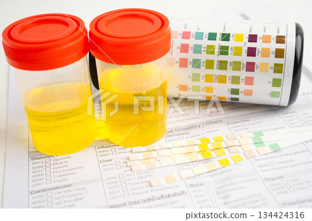 Urinalysis, urine cup with reagent strip pH paper test and comparison chart in laboratory. Urinalysis, urine cup with reagent strip pH paper test and comparison chart in laboratory. 134424316