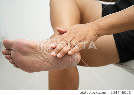 Asian woman check feet with crack and dry heel skin, Diabetic Foot. 134446098