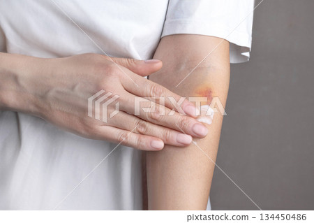 Woman hurt her hand. There is a bruise on the arm. A woman smears a hand with ointment from bruises. Anti-bruising cream, anti-inflammatory cream, pain cream. Cropped photo, close up Woman hurt her hand. There is a bruise on the arm. A woman smears a hand with ointment from bruises. Anti-bruising cream, anti-inflammatory cream, pain cream. Cropped photo, close up 134450486