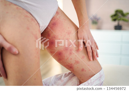 Woman's legs suffering from allergic rash skin redness Woman's legs suffering from allergic rash skin redness 134456972