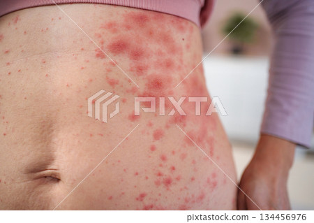 Woman experiencing skin rash on abdomen from allergic reaction Woman experiencing skin rash on abdomen from allergic reaction 134456976