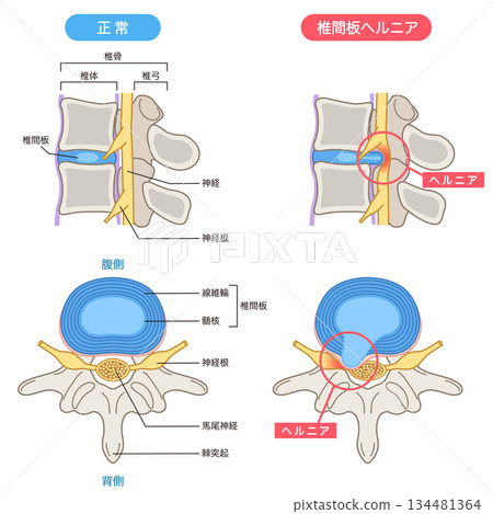 腰椎間盤突出結構 腰椎間盤突出結構 134481364