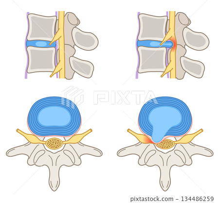 Lumbar disc herniation, structure of the intervertebral disc, lower back pain 134486259