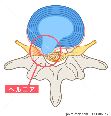 Lumbar disc herniation, structure of the intervertebral disc, lower back pain Lumbar disc herniation, structure of the intervertebral disc, lower back pain 134486347