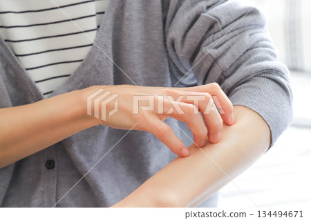 Woman scratching her arm, atopic eczema 134494671