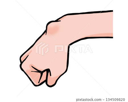 Illustration of a hand with a ganglion 134509820