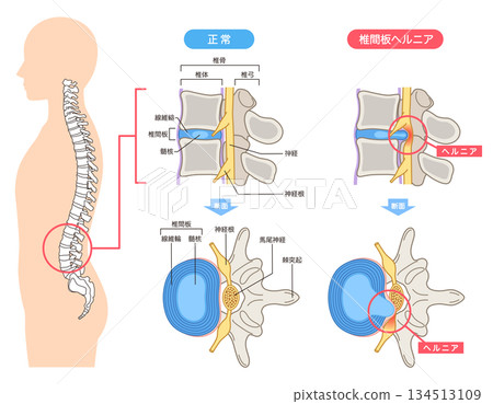 Lumbar disc herniation, structure of the intervertebral disc, lower back pain Lumbar disc herniation, structure of the intervertebral disc, lower back pain 134513109