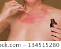 Applying serum to skin rash and allergy condition 134515280