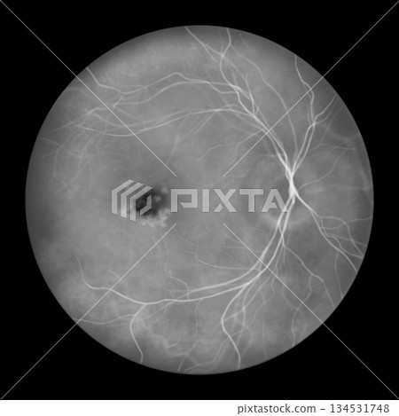Best disease stage 5, illustration 134531748