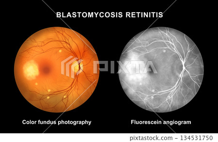 Ocular blastomycosis, illustration Ocular blastomycosis, illustration 134531750
