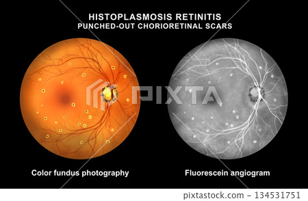 Punched-out chorioretinal scars in ocular histoplasmosis, illustration Punched-out chorioretinal scars in ocular histoplasmosis, illustration 134531751