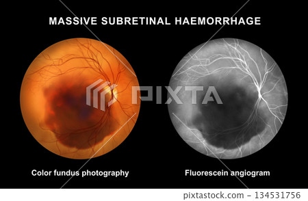 Massive subretinal hemorrhage, illustration 134531756