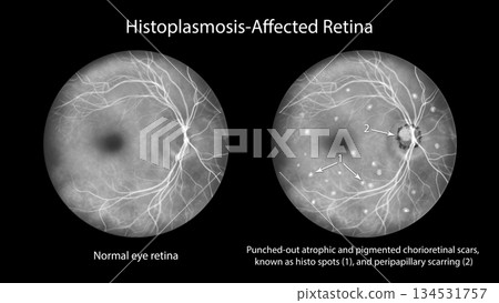 Punched-out chorioretinal scars in ocular histoplasmosis, illustration 134531757