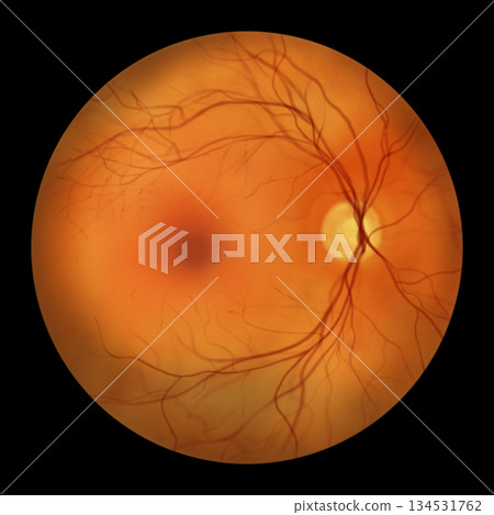 Retina with microaneurysms, illustration Retina with microaneurysms, illustration 134531762