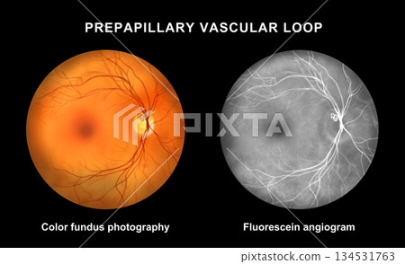 Prepapillary vascular loop, illustration 134531763