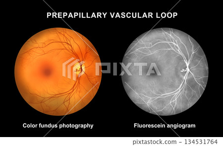 Prepapillary vascular loop, illustration 134531764