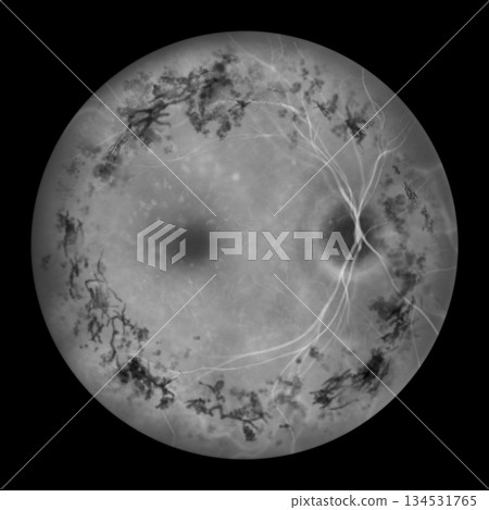 Retinitis pigmentosa, illustration Retinitis pigmentosa, illustration 134531765