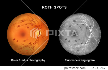 Roth spots, illustration Roth spots, illustration 134531767