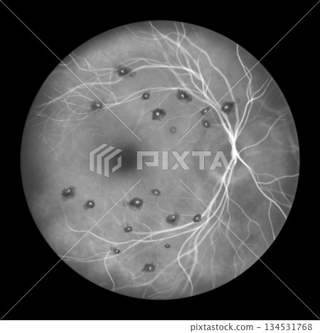 Roth spots, illustration Roth spots, illustration 134531768