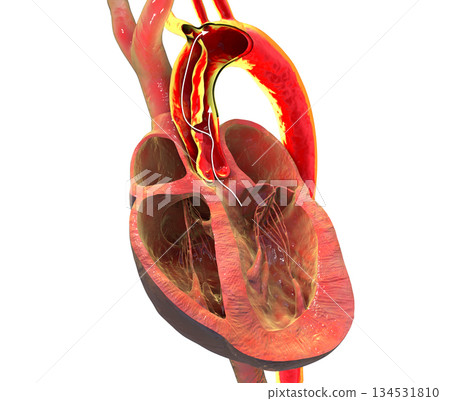 Ascending aortic dissection, 3D illustration 134531810