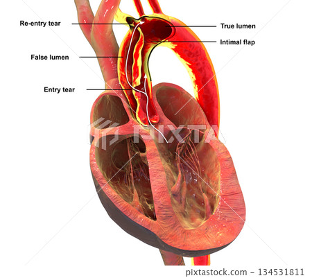 Ascending aortic dissection, 3D illustration 134531811