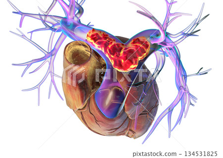 Saddle pulmonary embolism, 3D illustration. Saddle pulmonary embolism, 3D illustration. 134531825