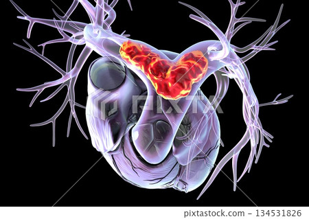 Saddle pulmonary embolism, 3D illustration. 134531826
