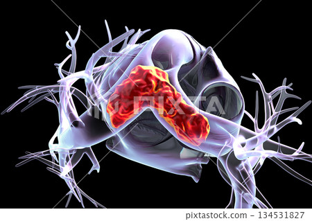 Saddle pulmonary embolism, 3D illustration. 134531827