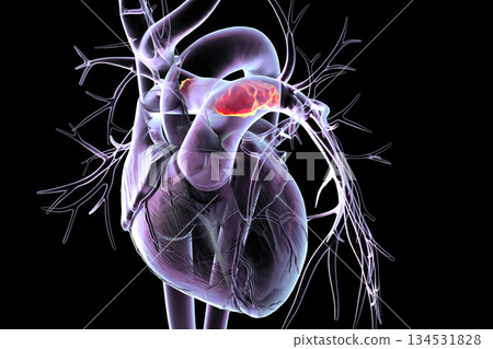 Saddle pulmonary embolism, 3D illustration. 134531828