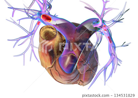 Small segmental or subsegmental pulmonary embolism, 3D illustration. Small segmental or subsegmental pulmonary embolism, 3D illustration. 134531829