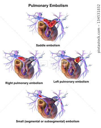 Pulmonary embolism types, 3D illustration. 134531832