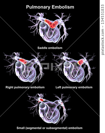 Pulmonary embolism types, 3D illustration. 134531833