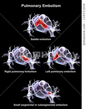 Pulmonary embolism types, 3D illustration. Pulmonary embolism types, 3D illustration. 134531834